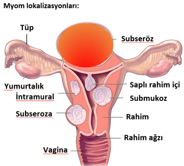 Miyom Belirtisi Nedir, Miyomdan Korunma Yöntemleri Nelerdir?