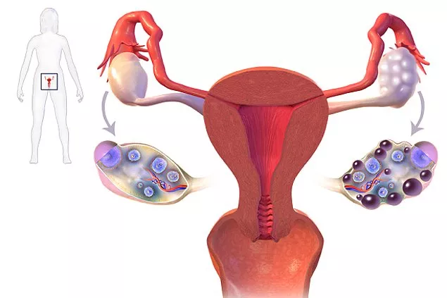 Polikistik Over Sendromu (PCOS)