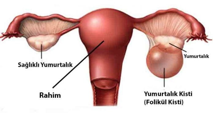 Yumurtalık Kistleri